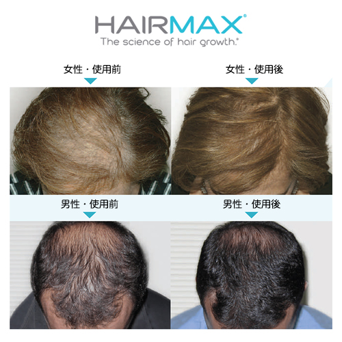 ヘアマックス レーザーバンド82　HAIRMAXヘアーマックス