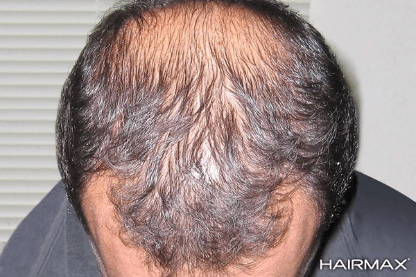 HairMax Japan